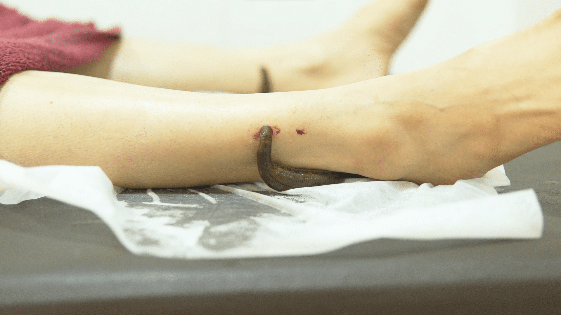 Leech Therapy Jalaukavacharana