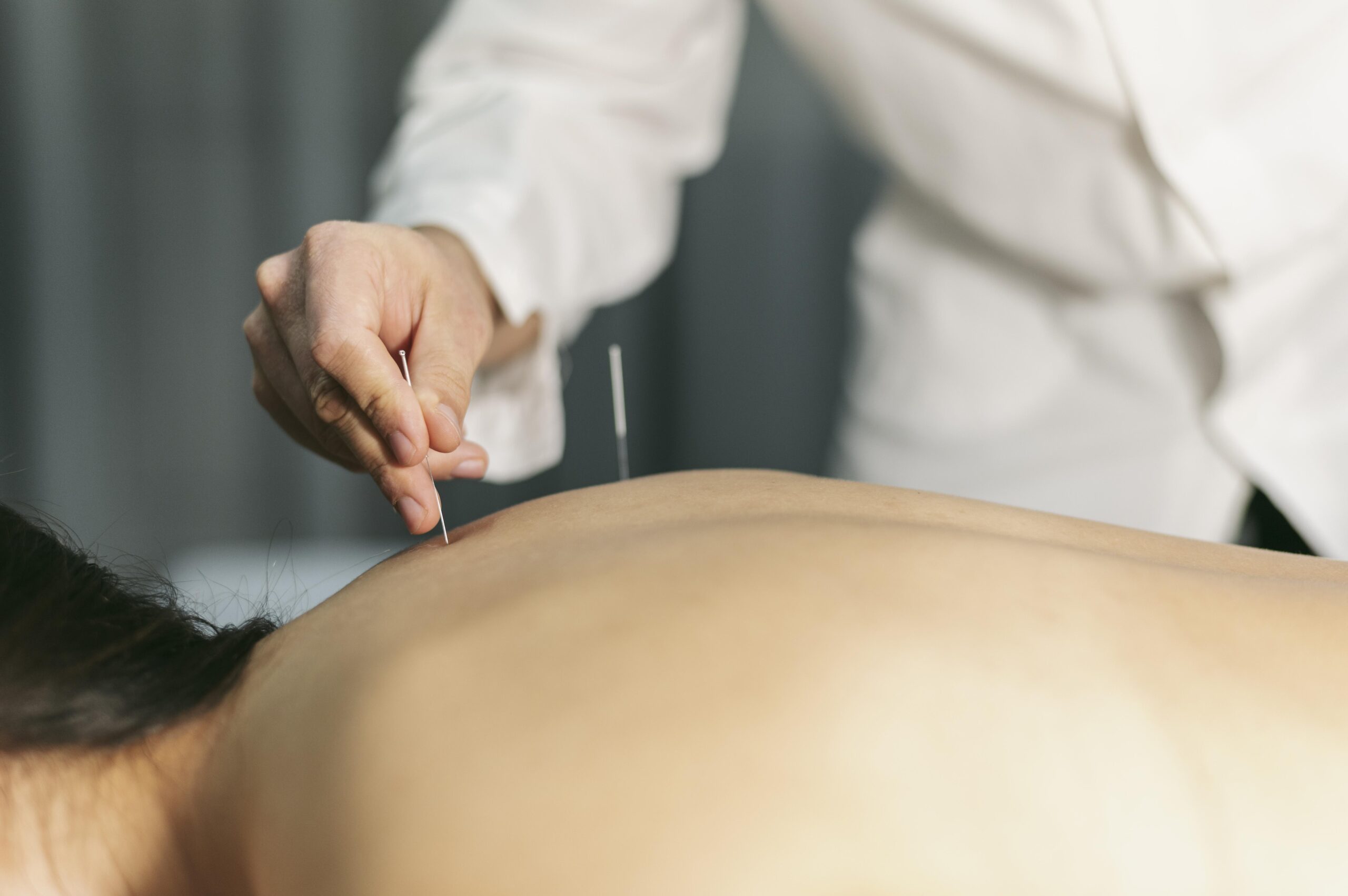Viddhakarma Ayurvedic Acupuncture
