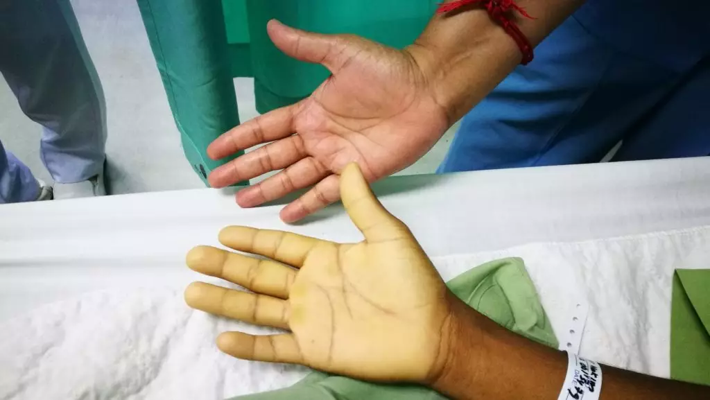 Anaemia Ayurvedic Treatment