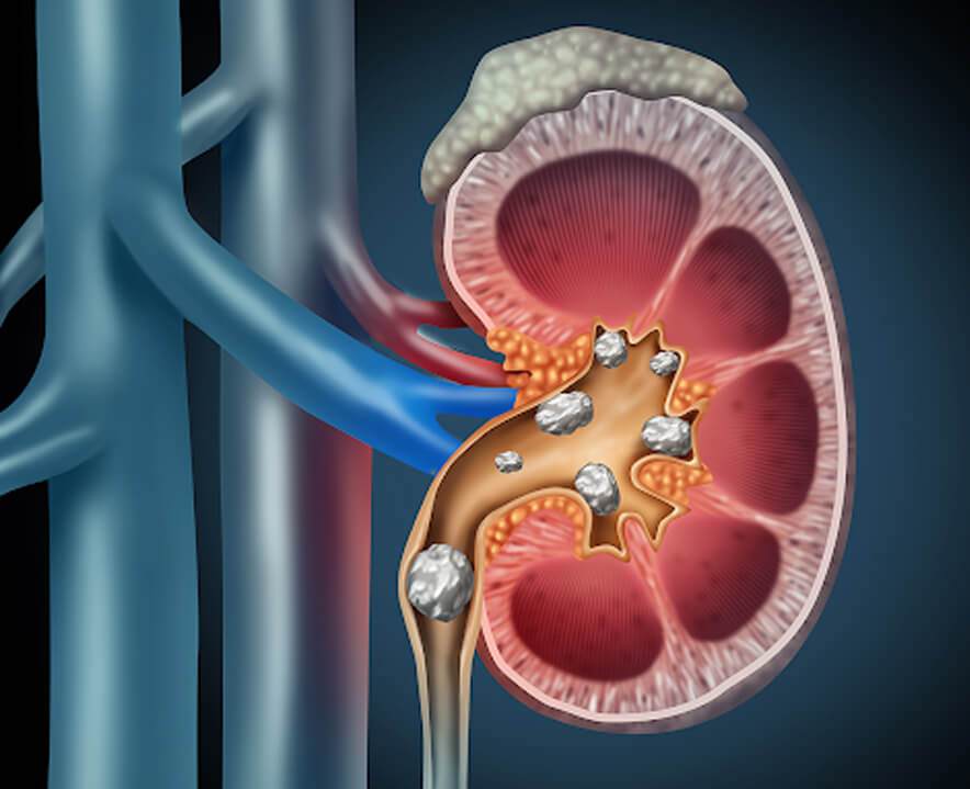 Kidney Stone Ayurvedic Treatment