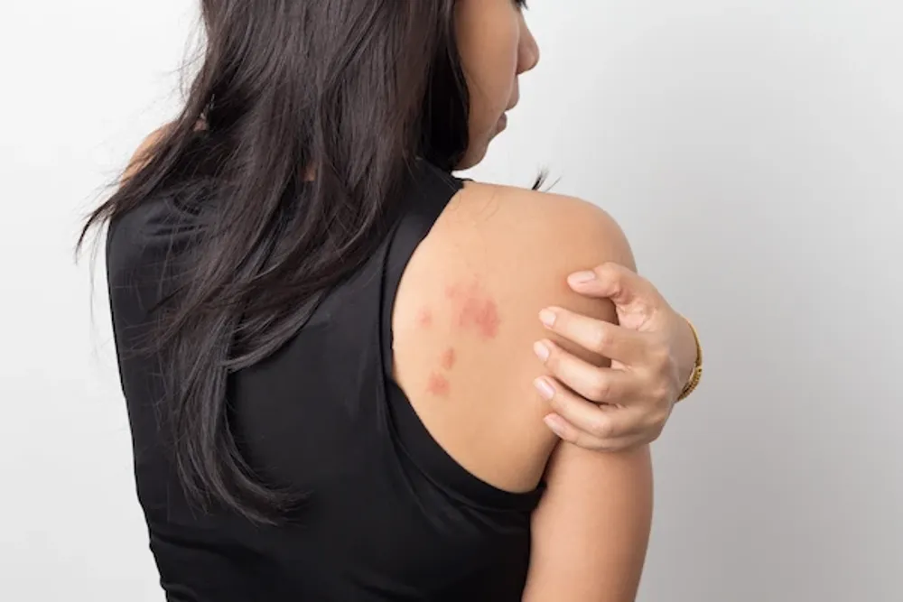 Skin Diseases Psoriasis Treatment
